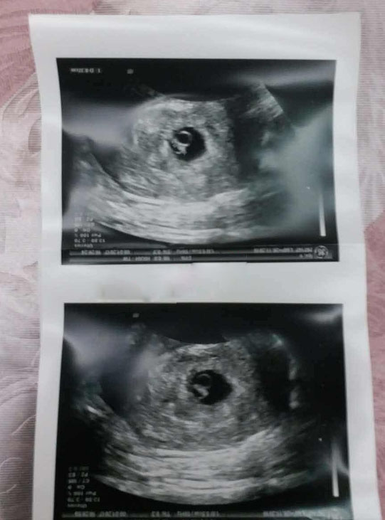 33岁多囊输卵管堵塞做泰国试管成功怀孕